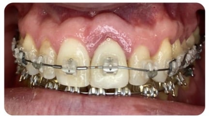 Braces - Level Orthodontics